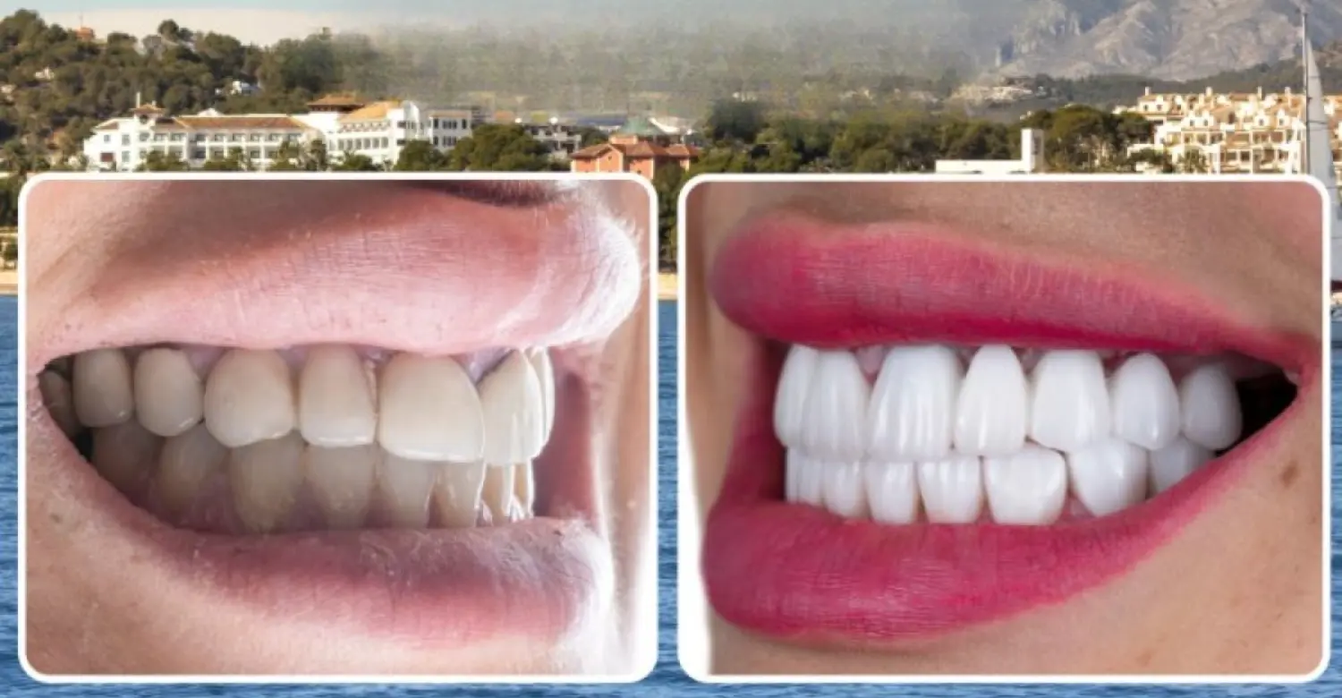 No Prep Veneers Turkey 2